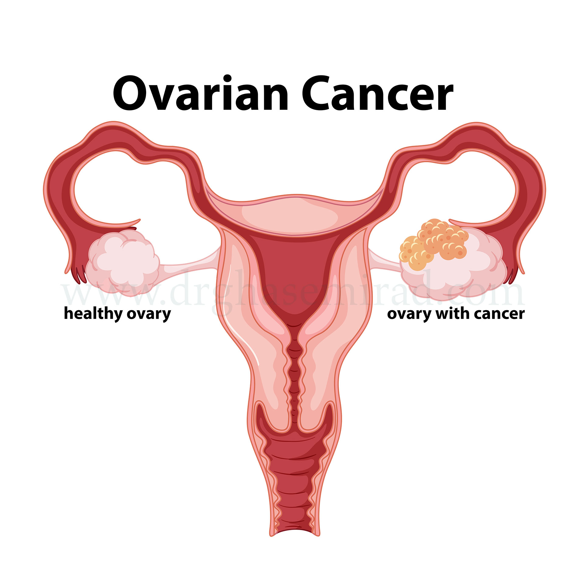 سرطان تخمدان