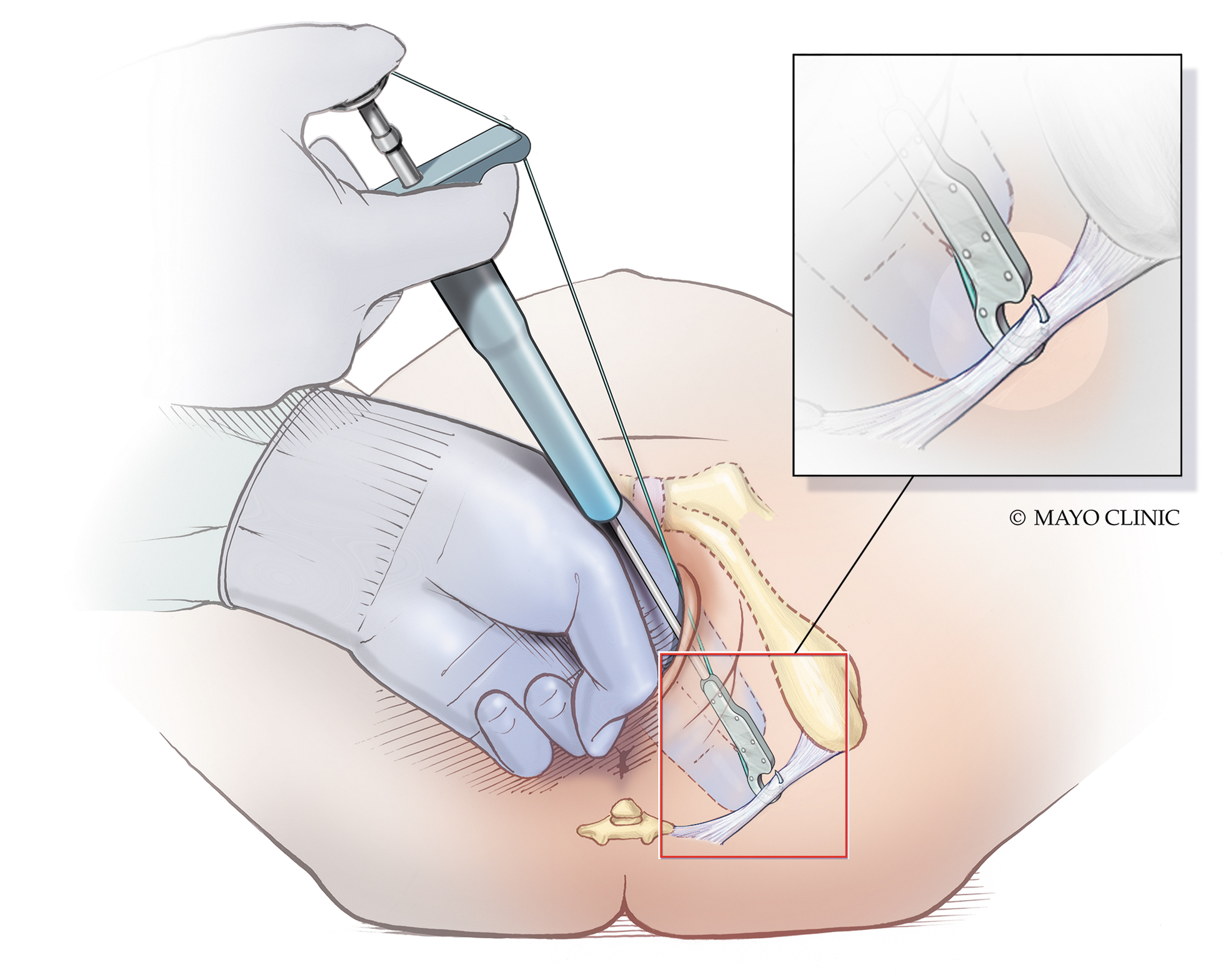 پرینورافی در کرمان