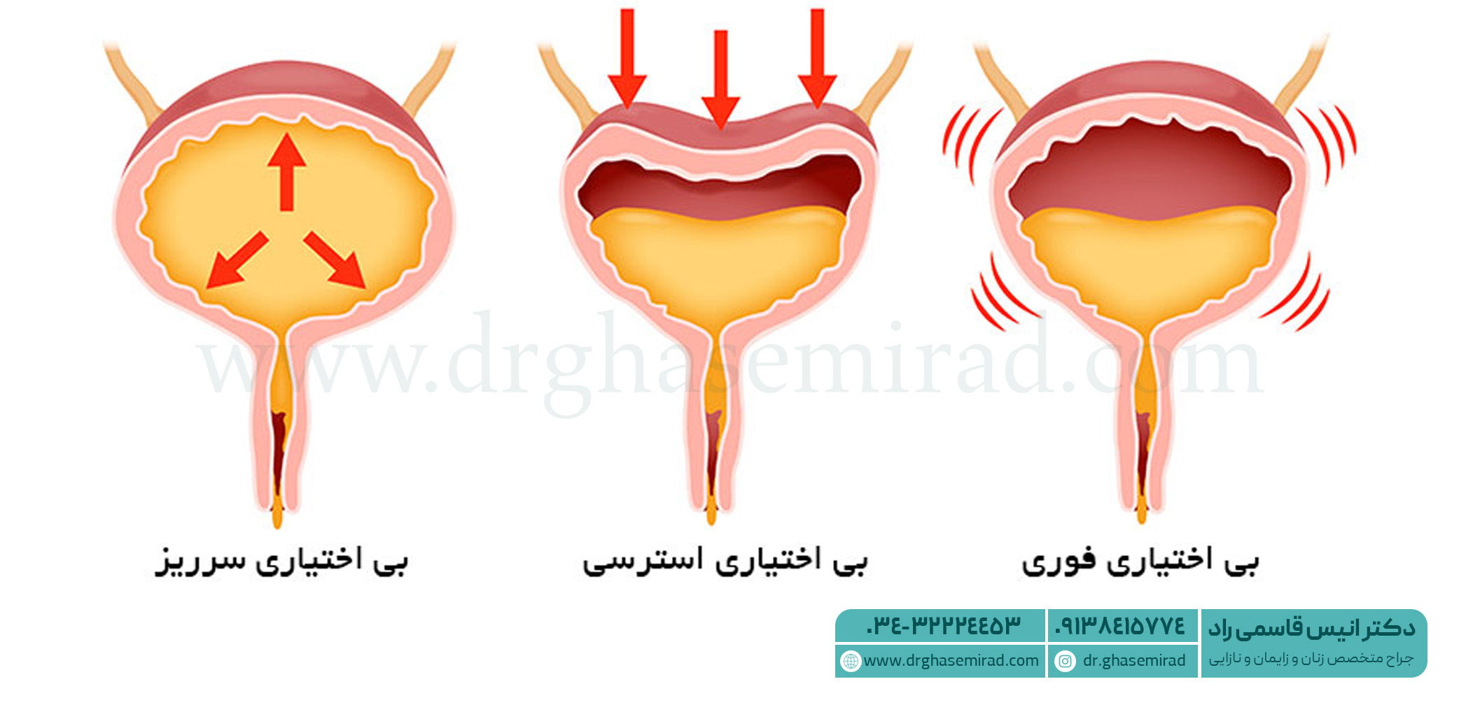 بی اختیاری ادرار در بانوان