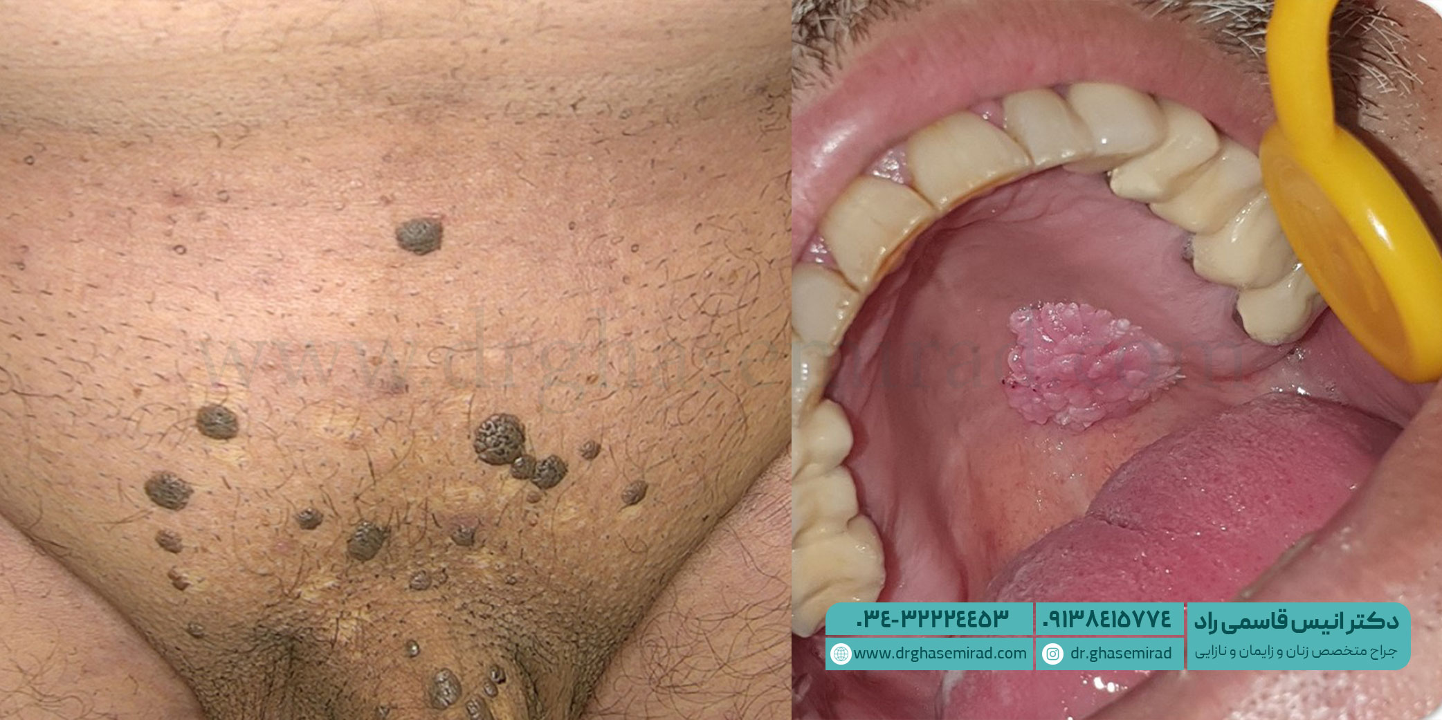 بیماری مقاربتی HPV