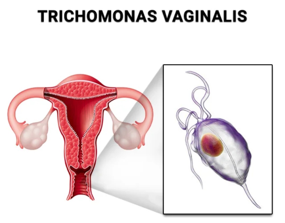 درمان خانگی عفونت تریکوموناس