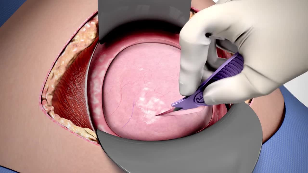 در سزارین چند لایه برش می‌خورد؟