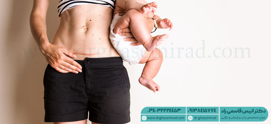 انواع روش‌های عمل سزارین
