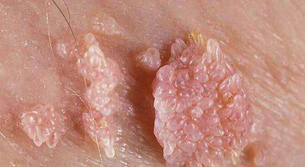 زندگی با ویروس HPV