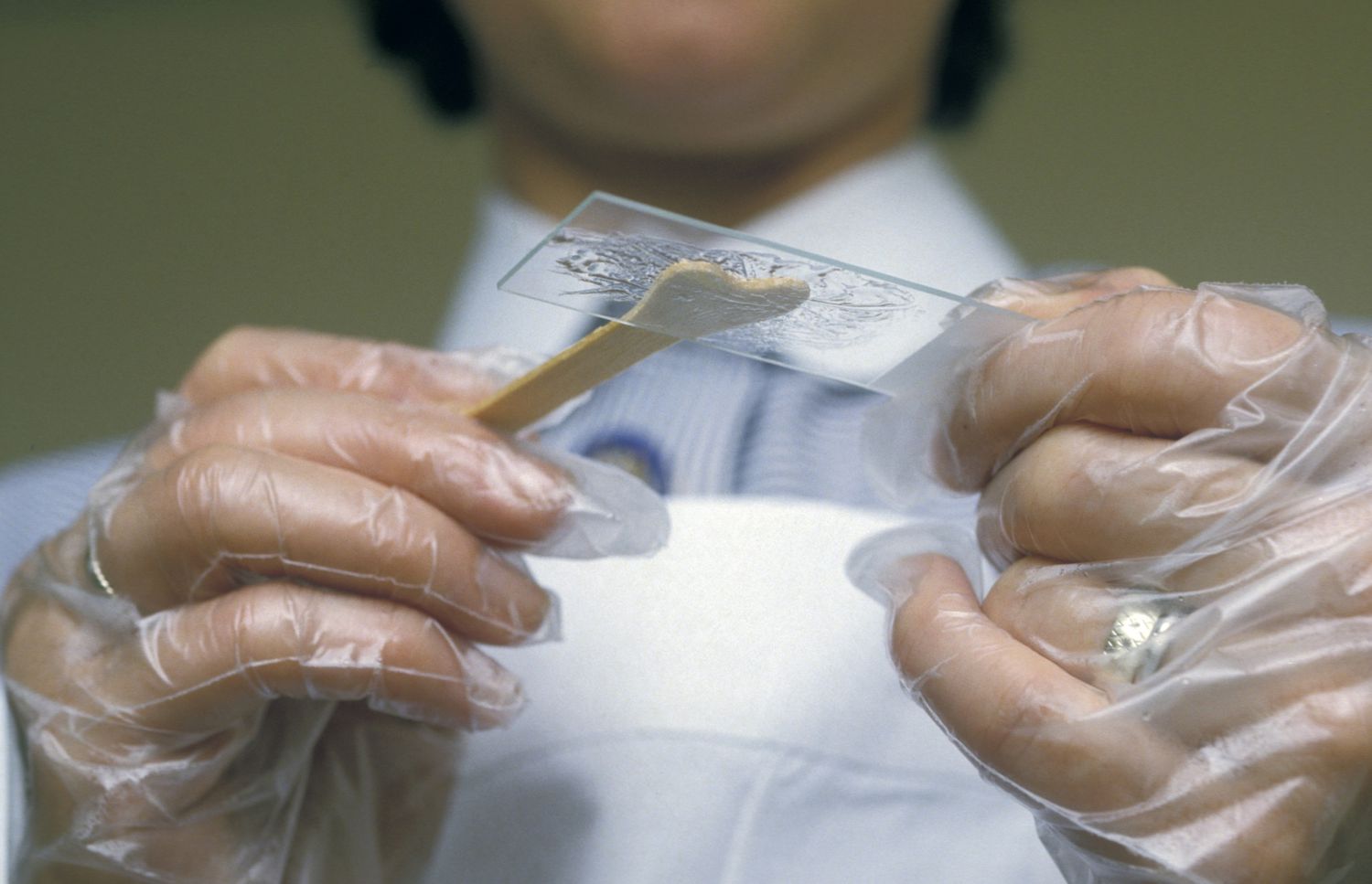 اهمیت تست پاپ اسمیر در تشخیص زودهنگام HPV