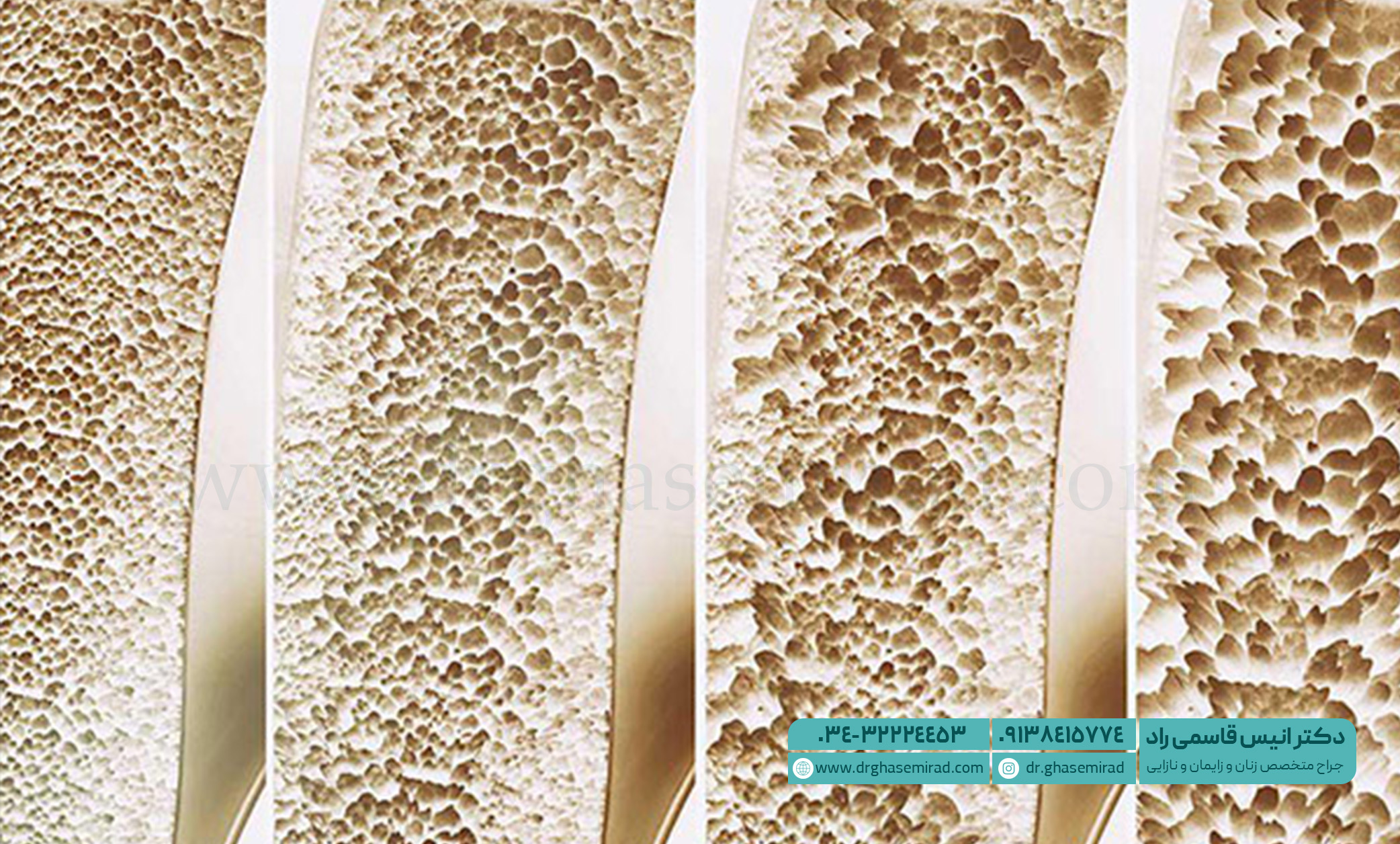 پوکی استخوان در یائسگی