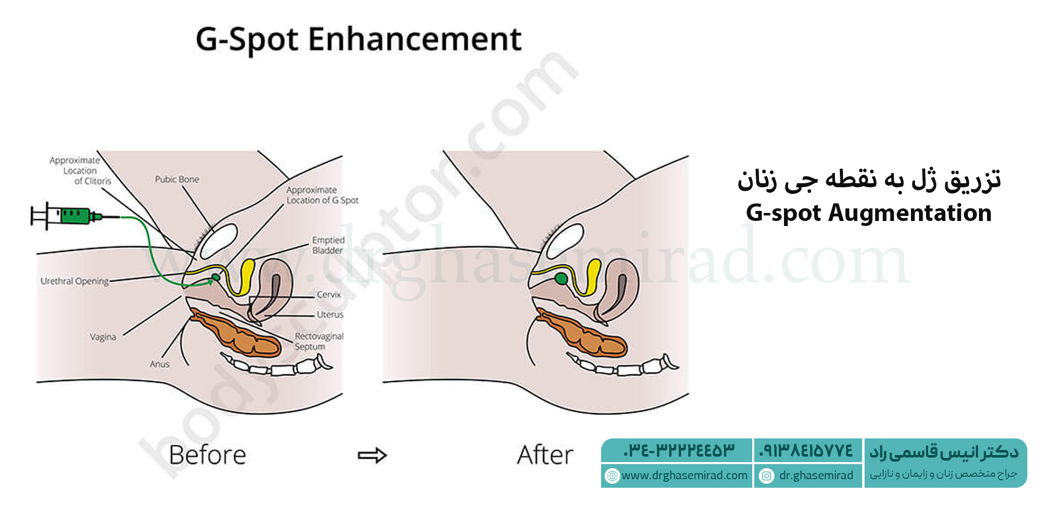 افزایش لذت جنسی با تزریق ژل به نقطه جی