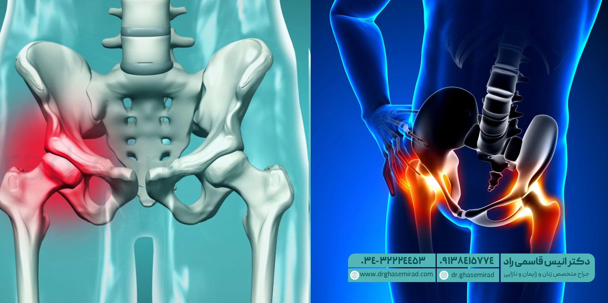 ارتباط کاهش استروژن با ضعف کف لگن