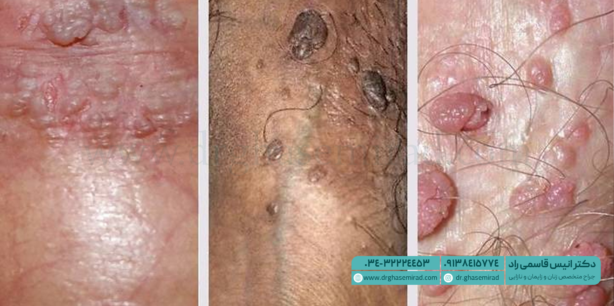hpv نوع 6 و 11