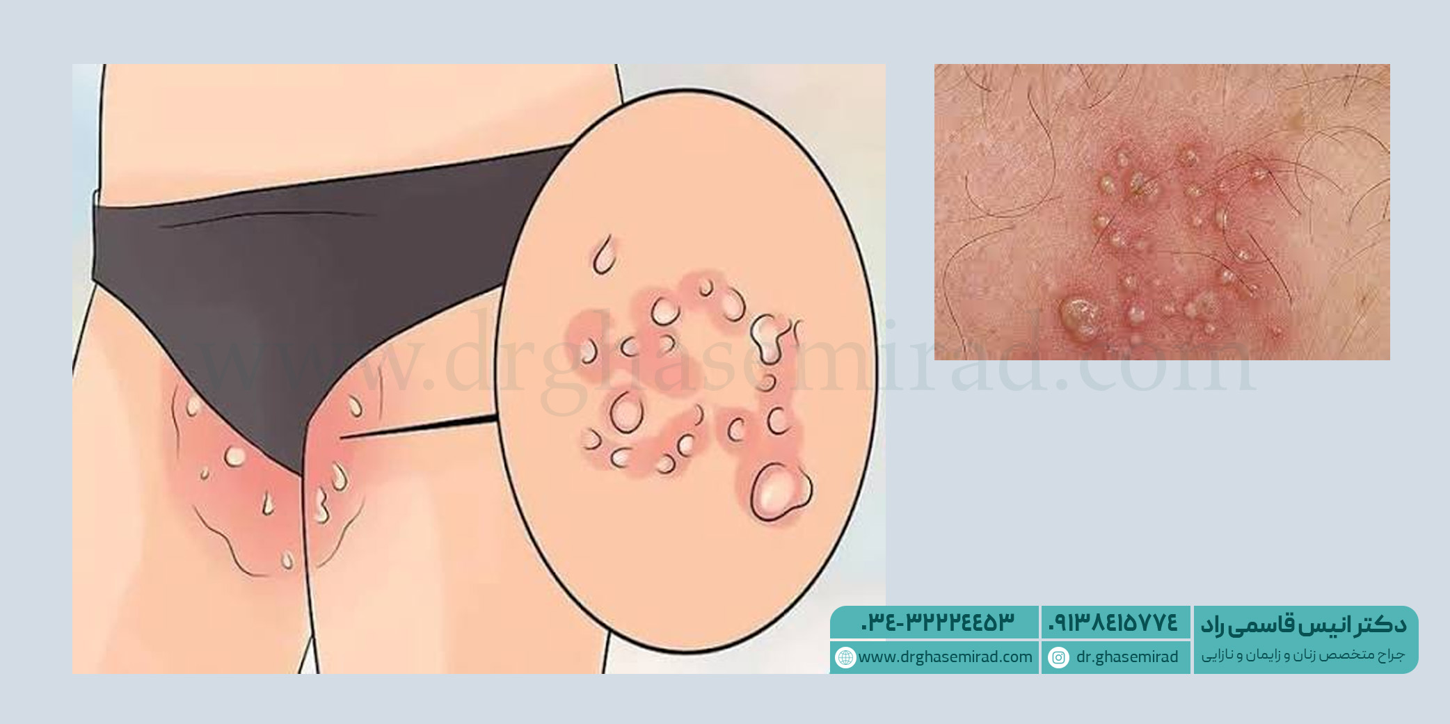 زگیل تناسلی hpv در قسمت کشاله ران