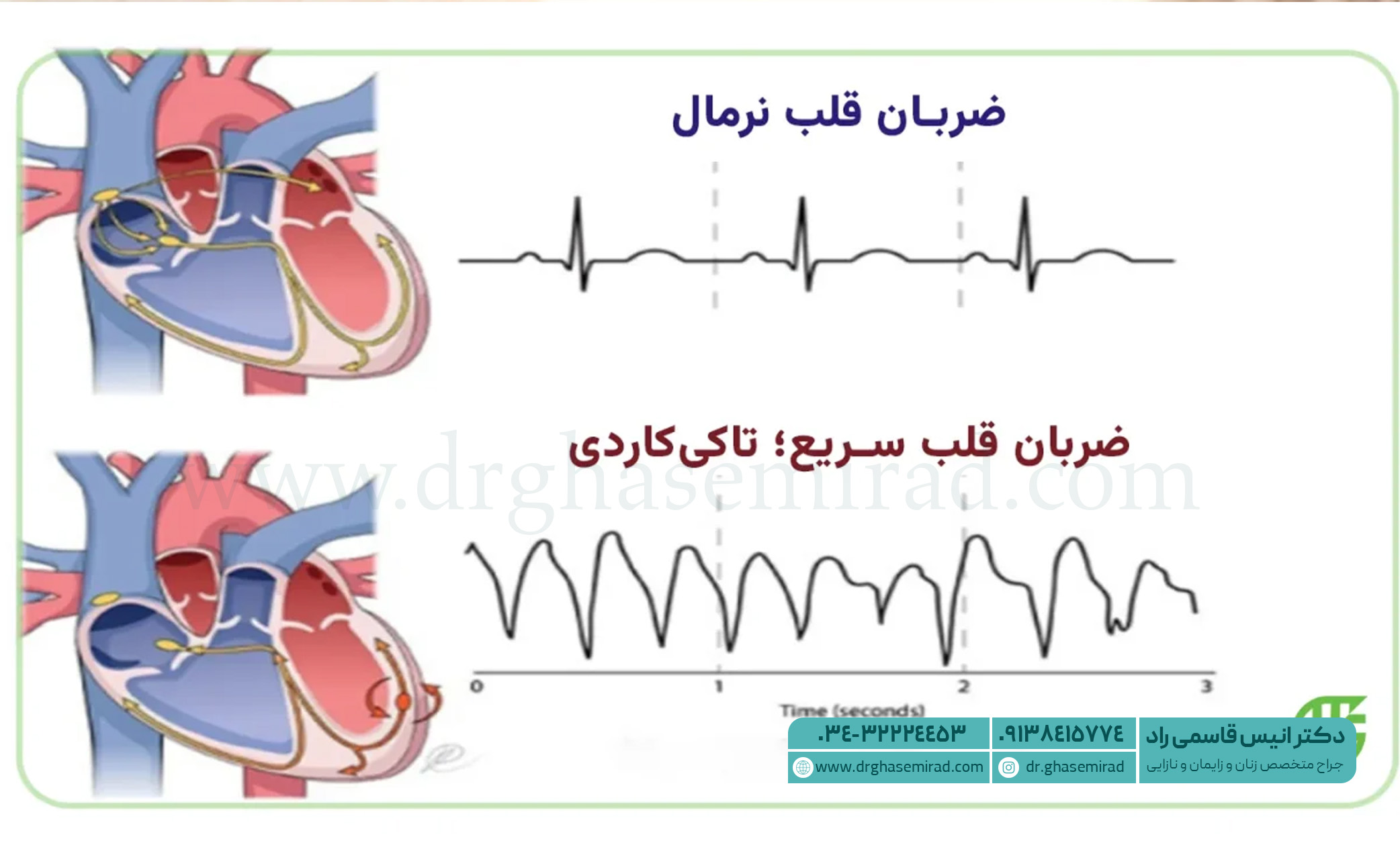 تاکی کاردی چیست